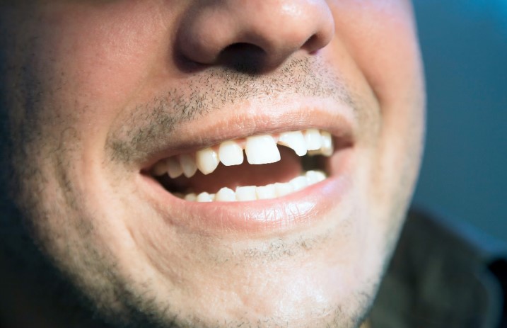 stories/broken-teeth.jpg