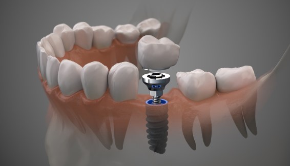 stories/dental-implants.jpg