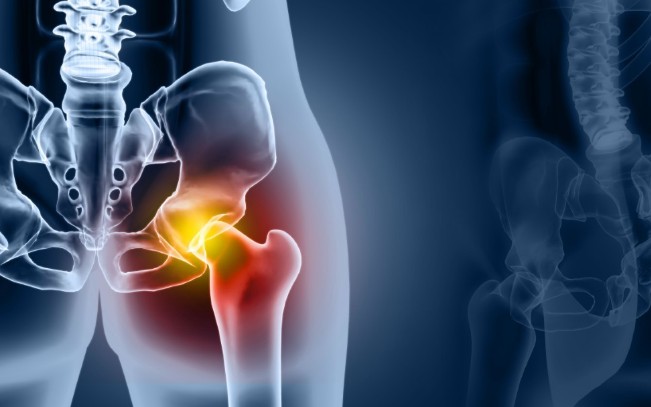 stories/hip-injury-x-ray.jpg