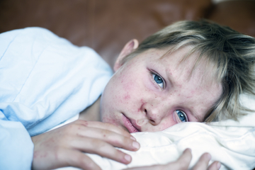 stories/measles-child.jpg